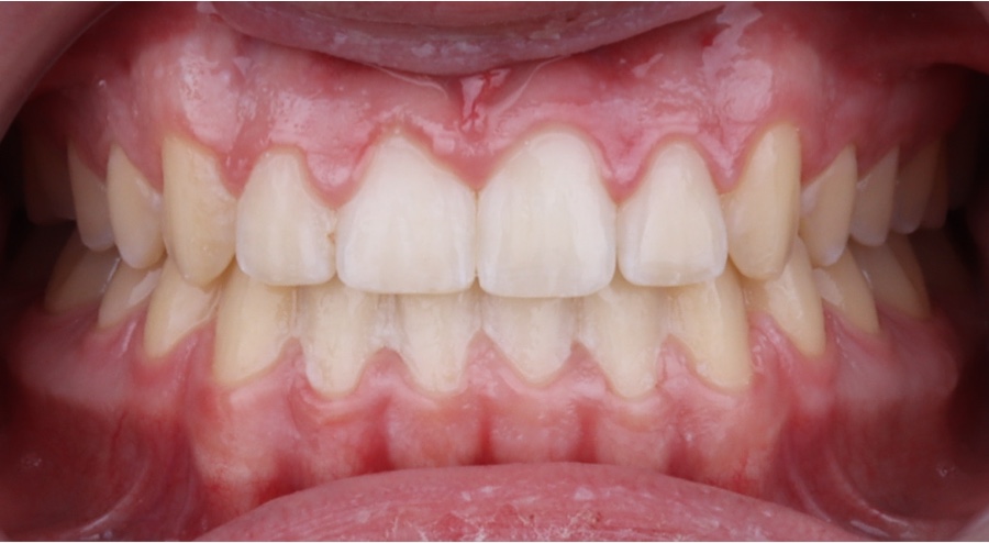 after orthodontics photo