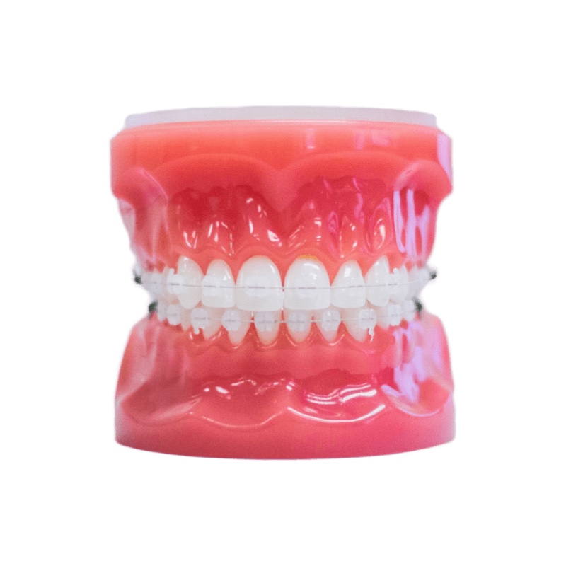 clear braces on model
