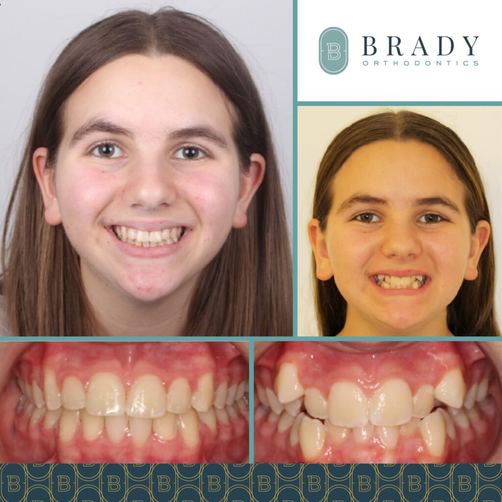Orthodontics Before and Afters
