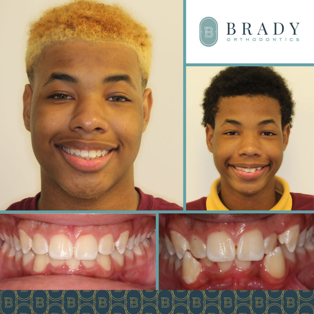 Orthodontics Before and Afters