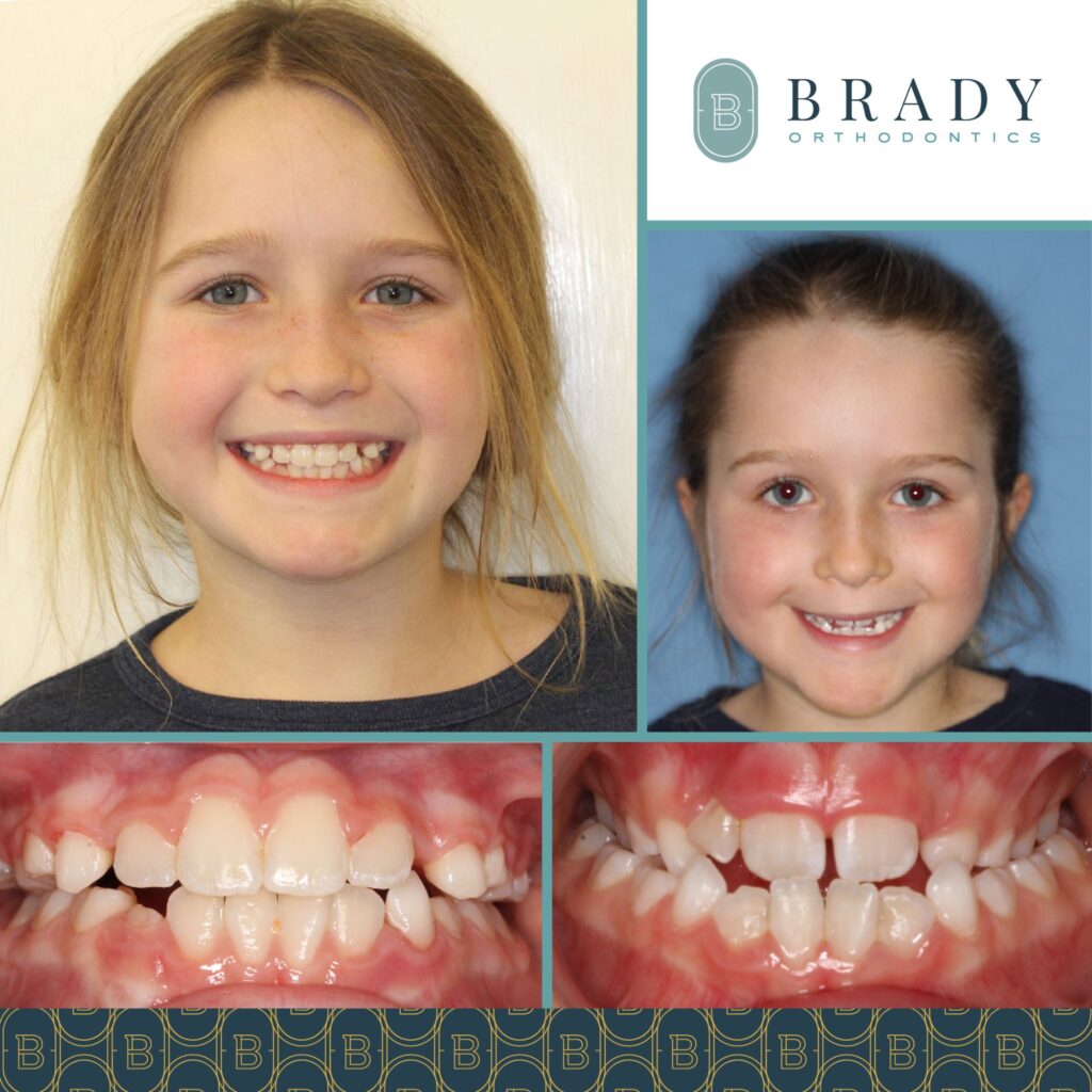 Orthodontics Before and Afters
