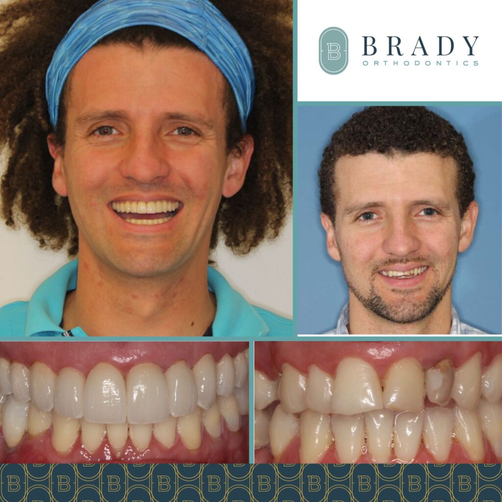 Orthodontics Before and Afters