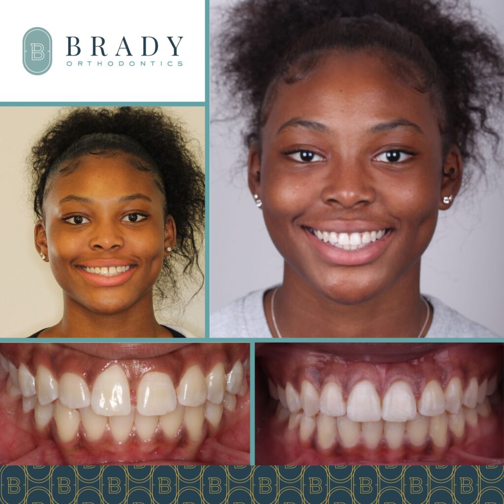 Orthodontics Before and Afters