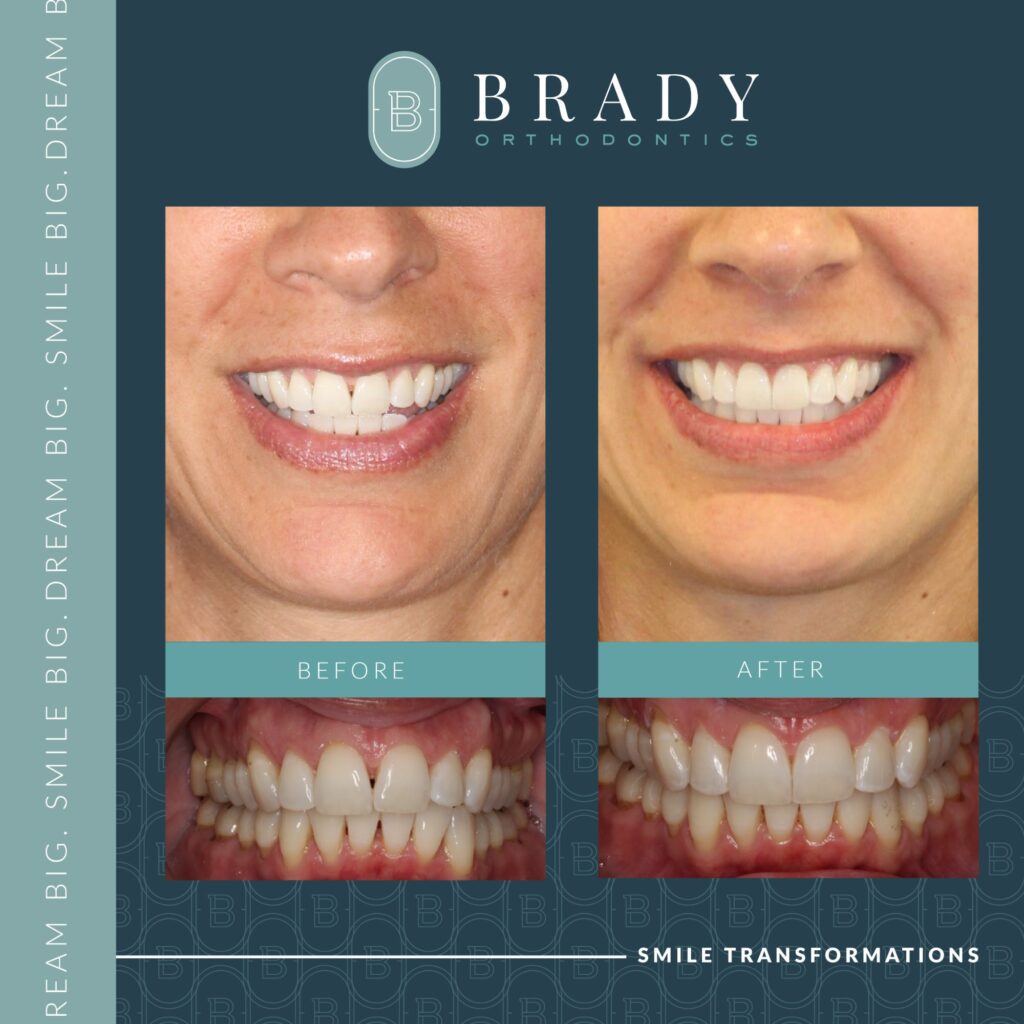 Orthodontics Before and Afters
