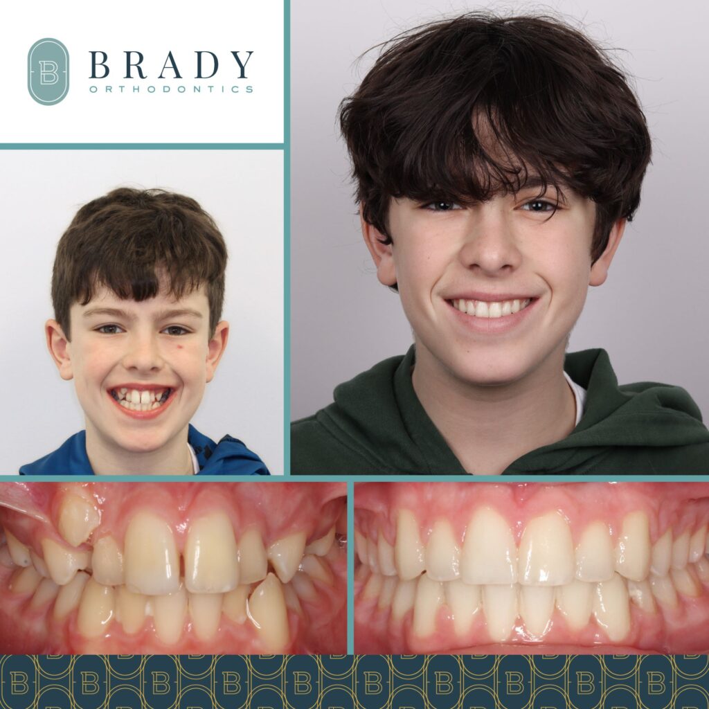 Orthodontics Before and Afters
