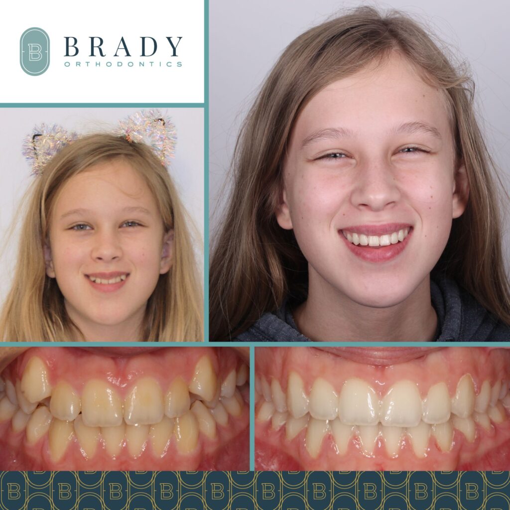 Orthodontics Before and Afters