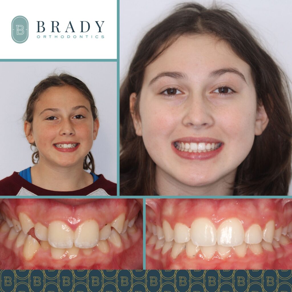 Orthodontics Before and Afters