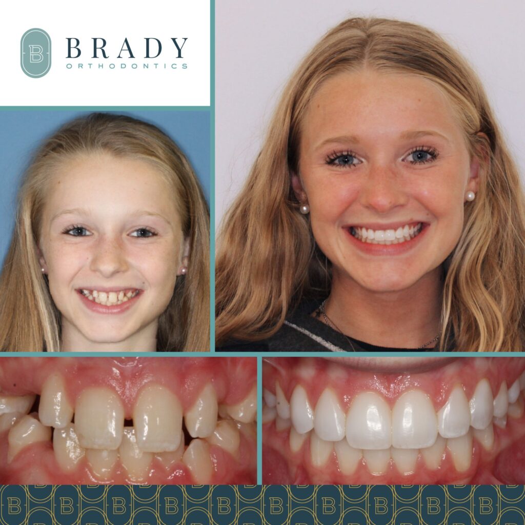 Orthodontics Before and Afters