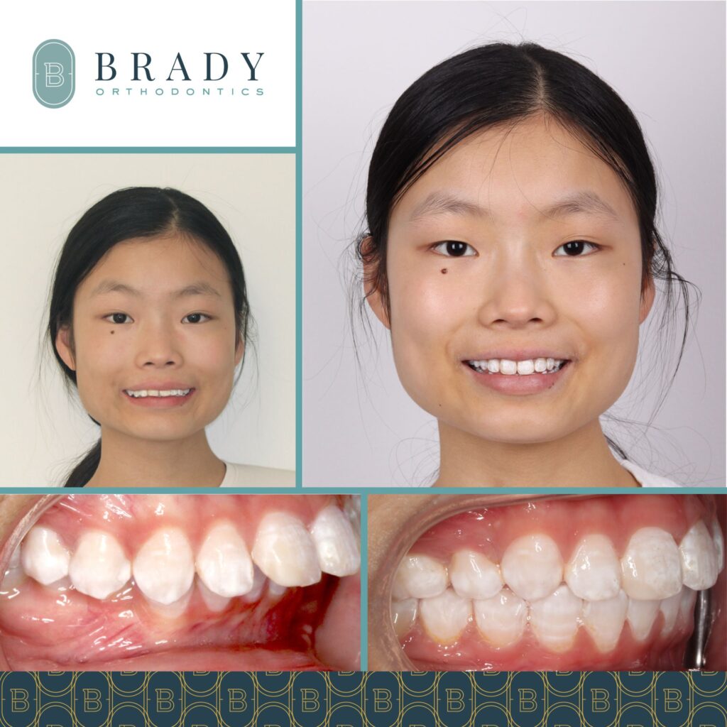 Orthodontics Before and Afters