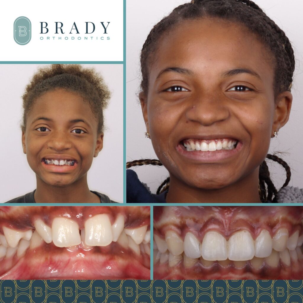 Orthodontics Before and Afters
