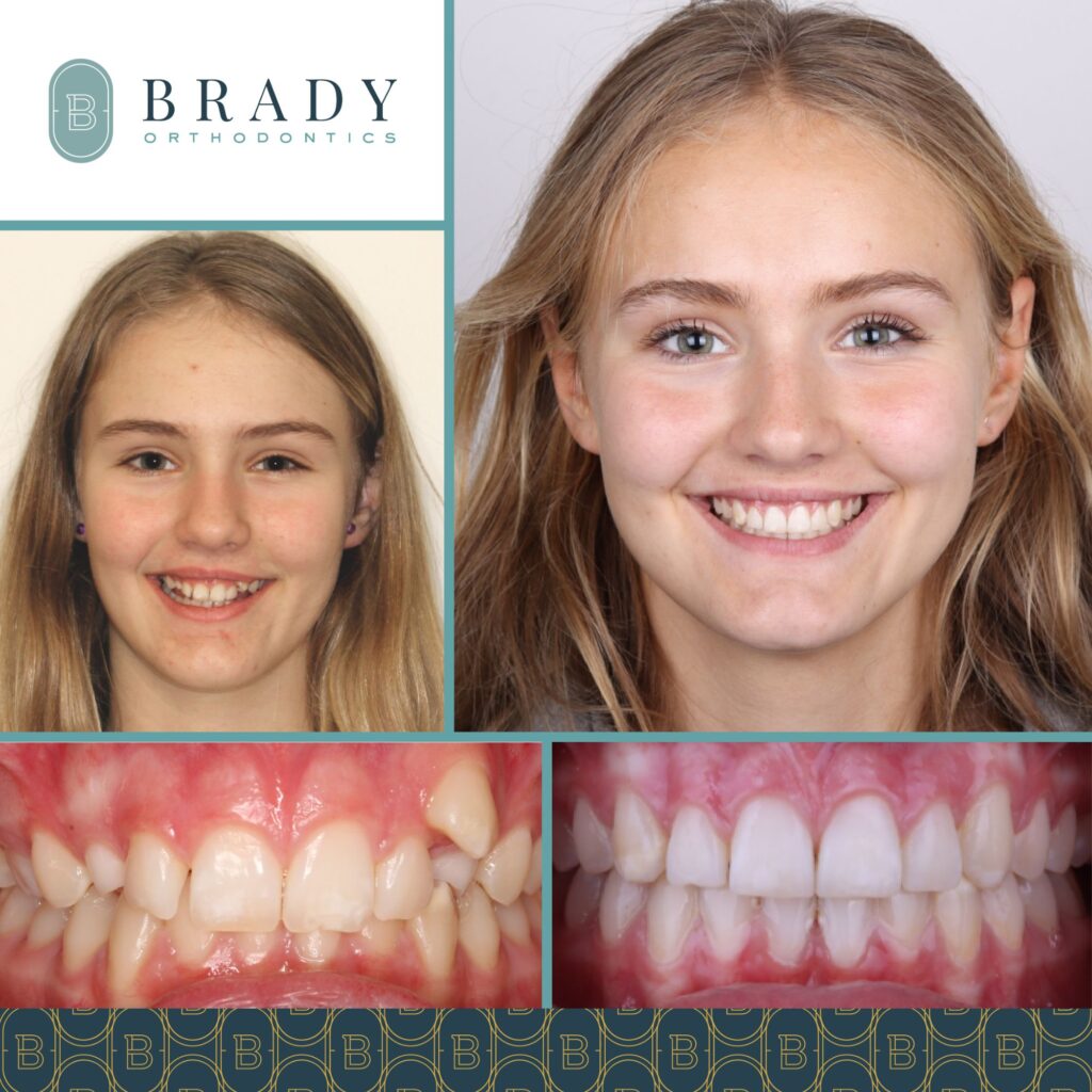 Orthodontics Before and Afters