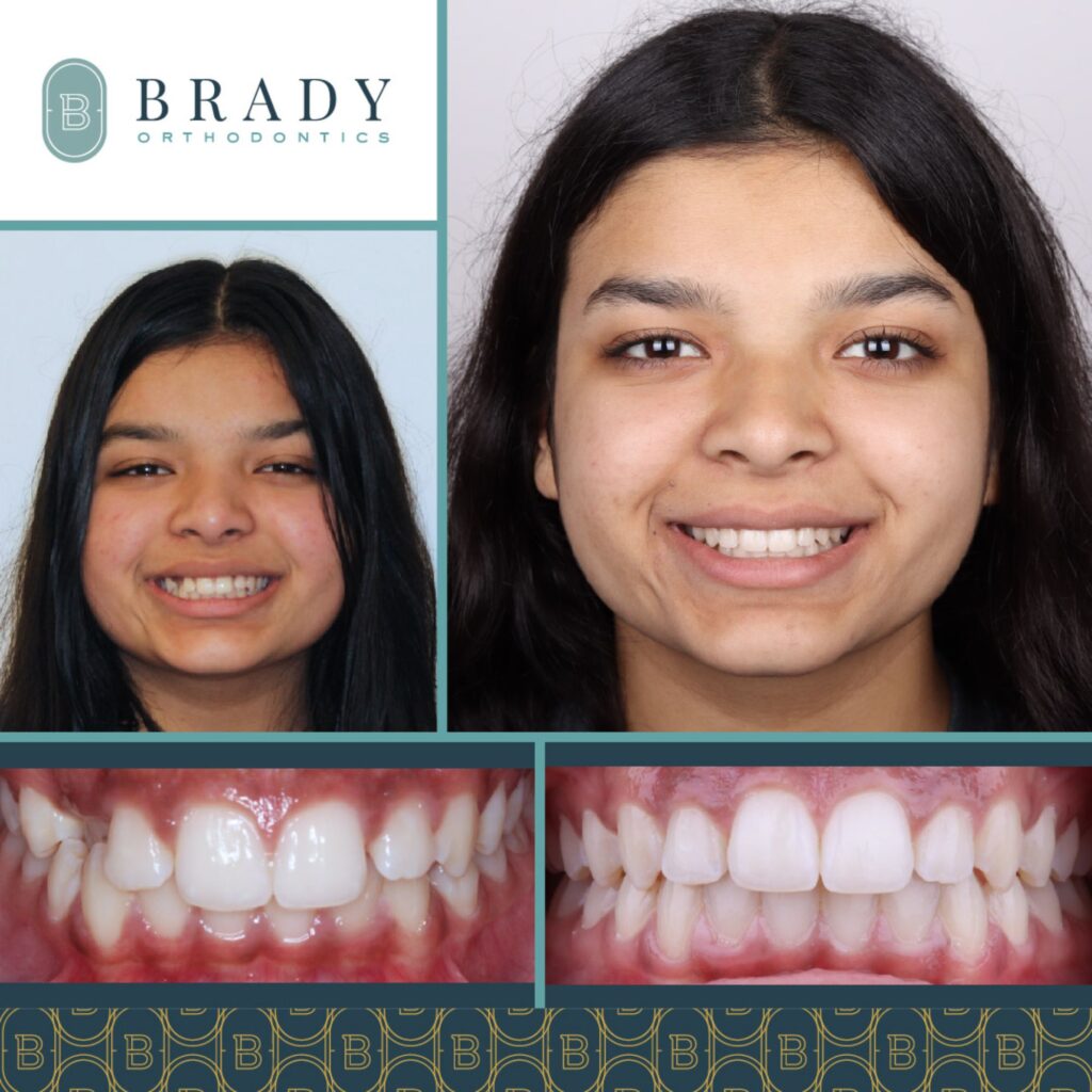 Orthodontics Before and Afters