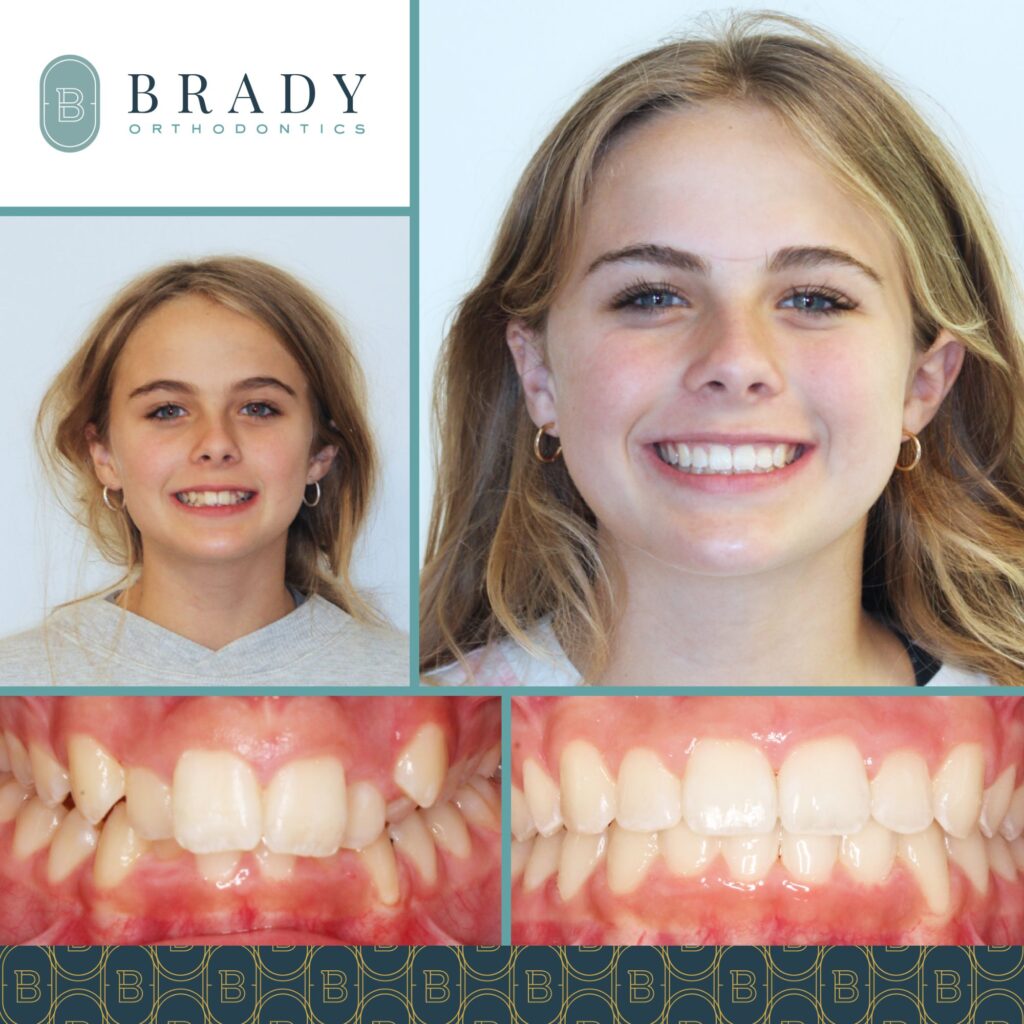 Orthodontics Before and Afters