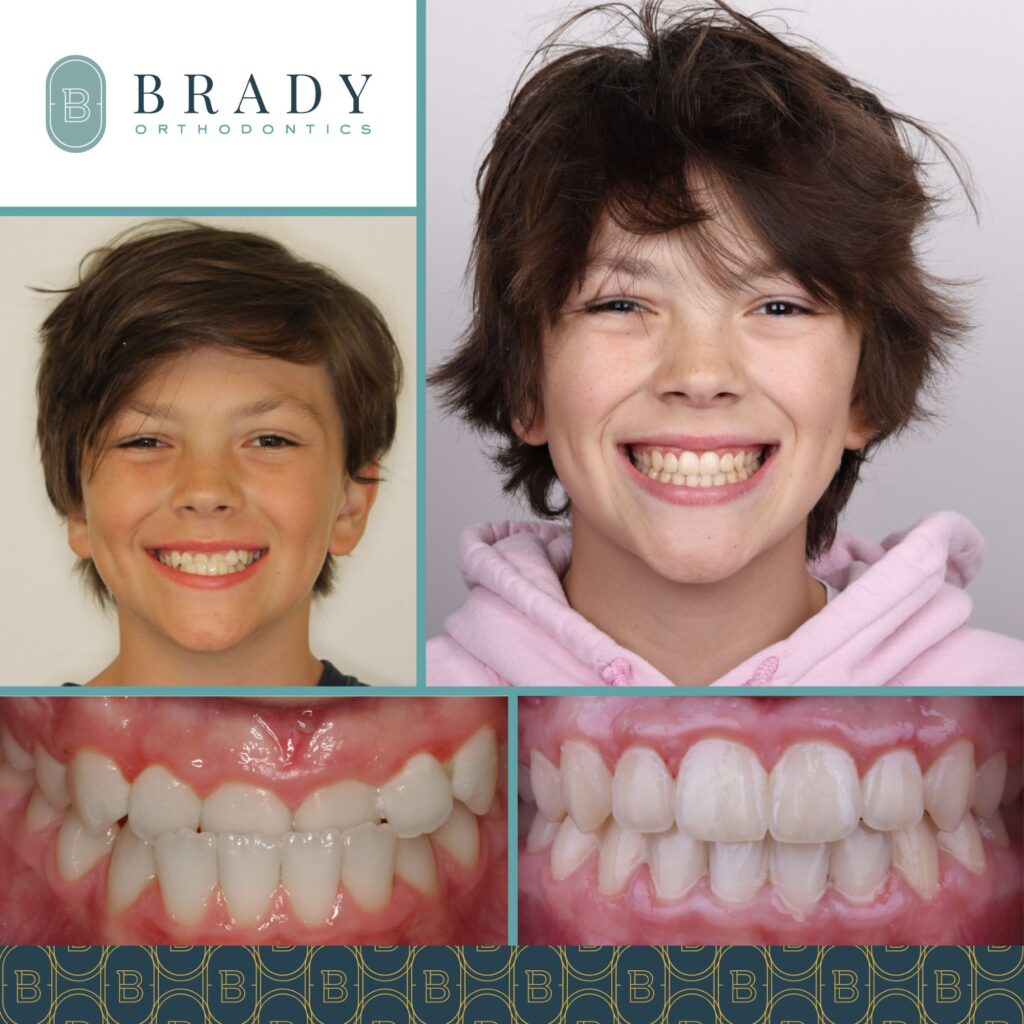Orthodontics Before and Afters