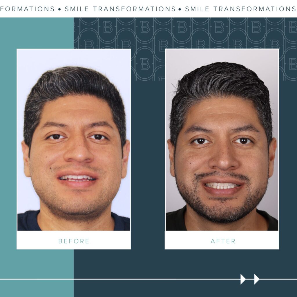 Orthodontics Before and Afters