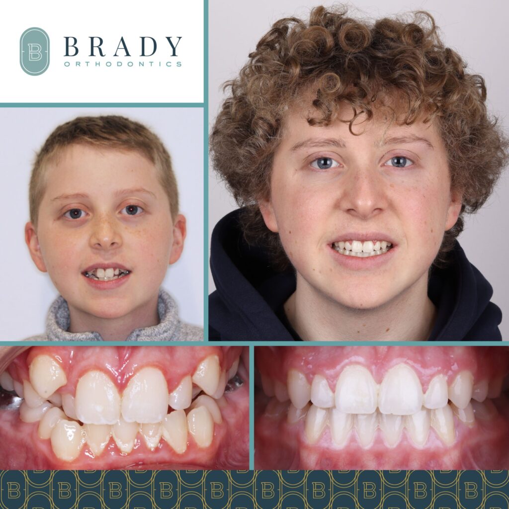 Orthodontics Before and Afters