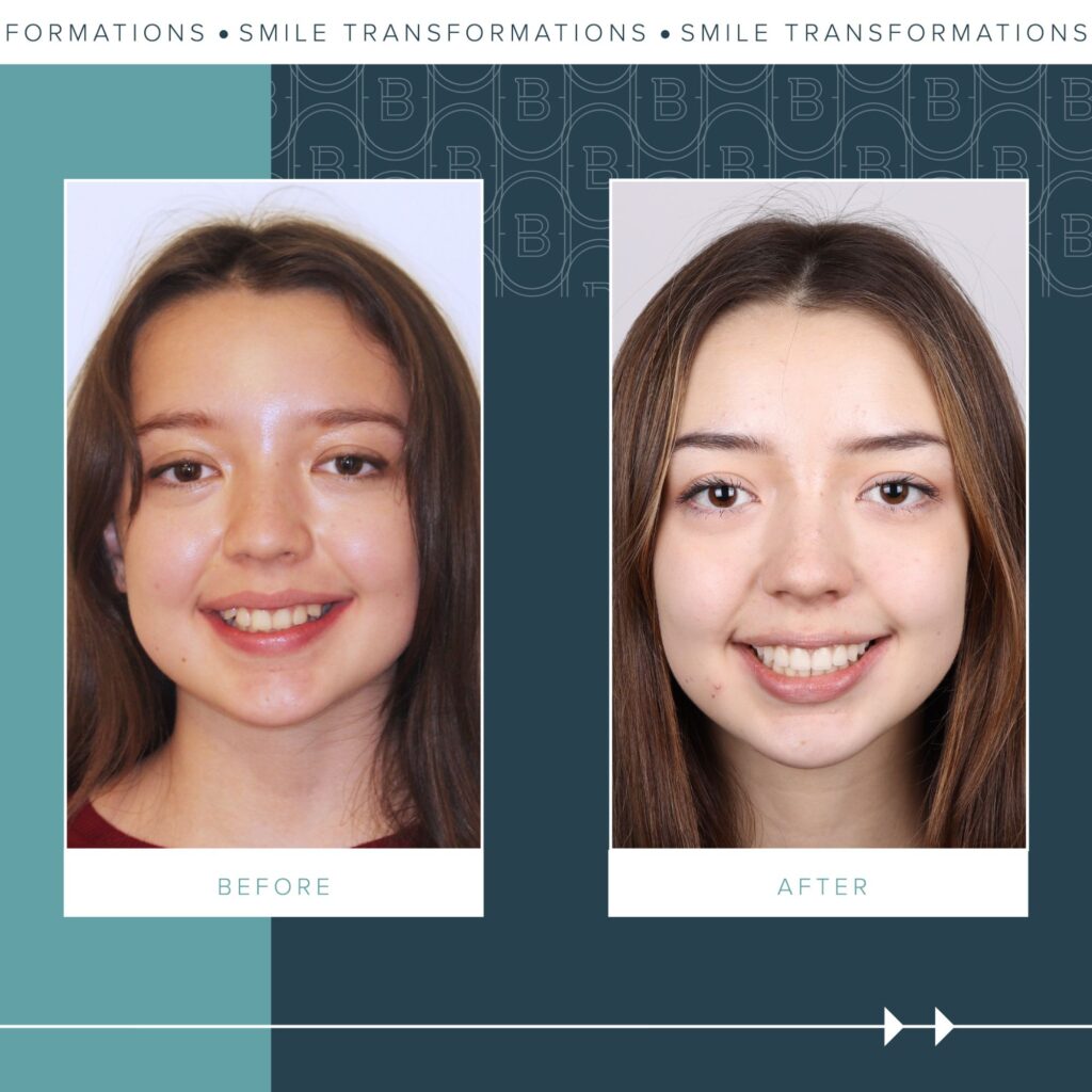 Orthodontics Before and Afters
