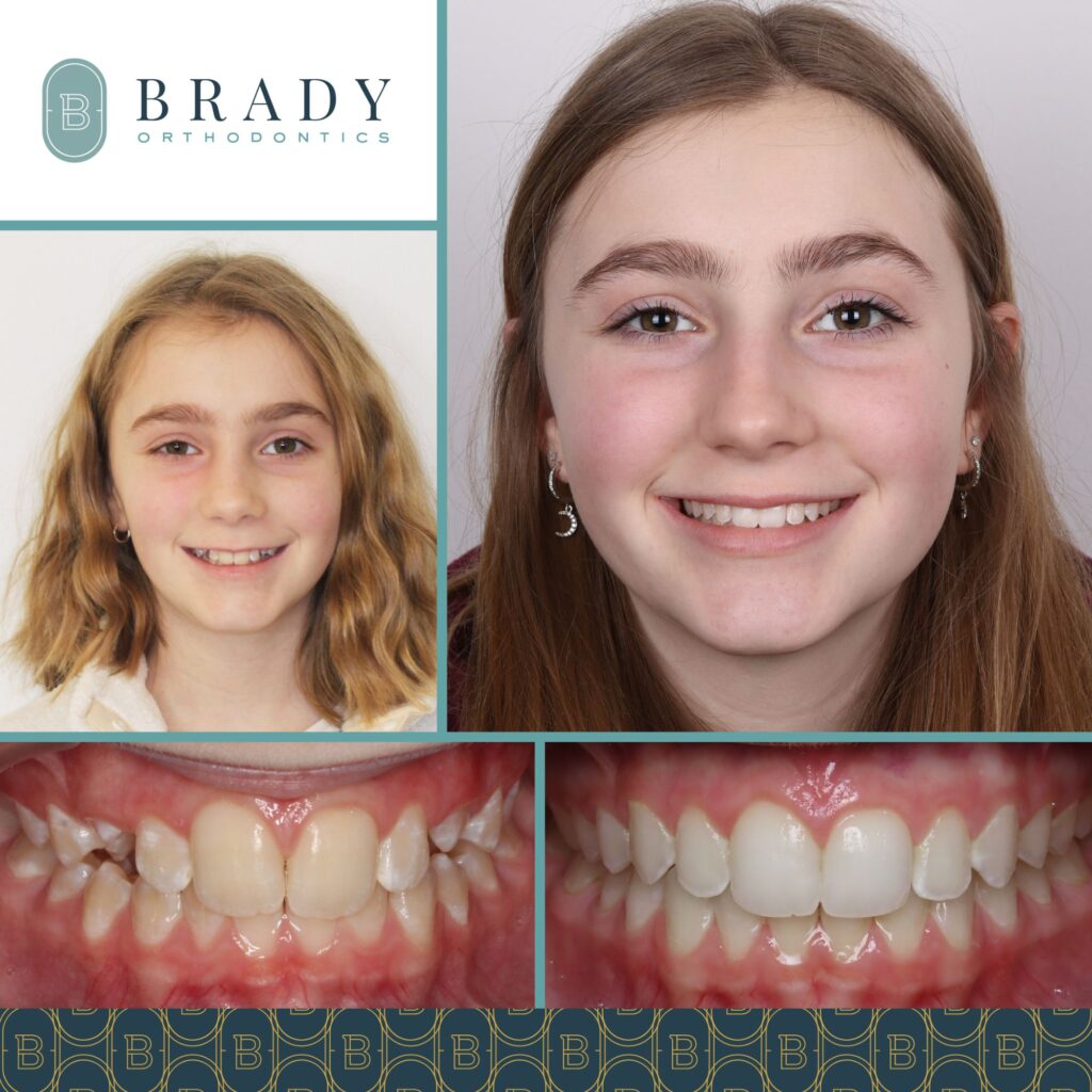 Orthodontics Before and Afters