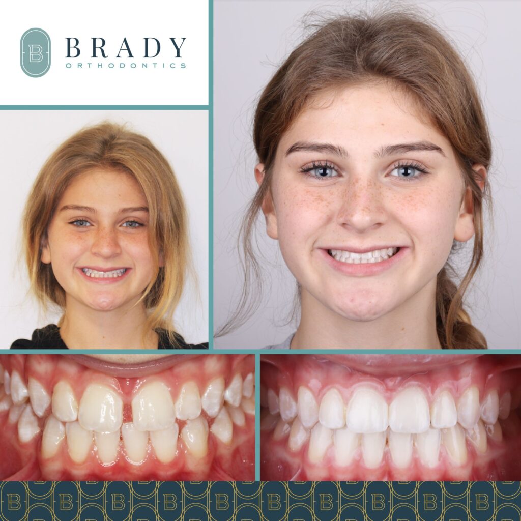 Orthodontics Before and Afters