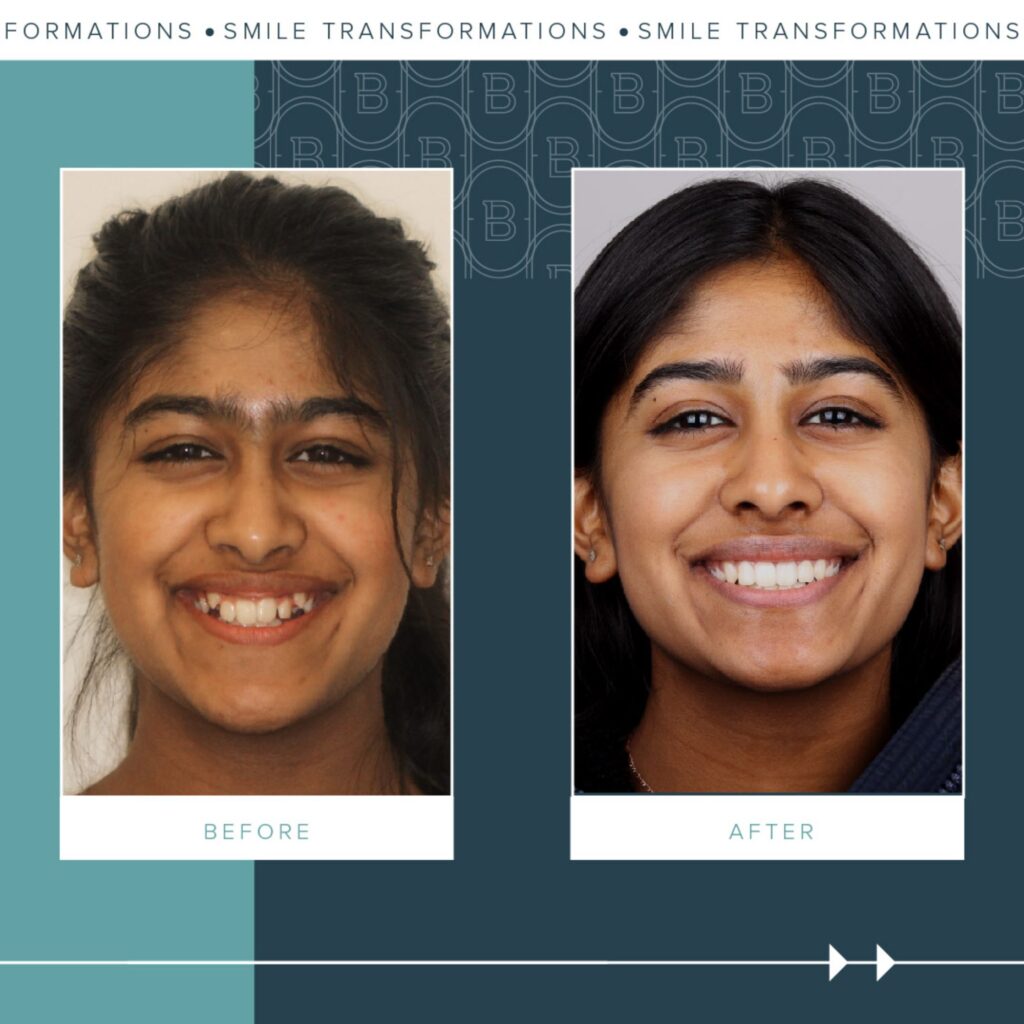 Orthodontics Before and Afters