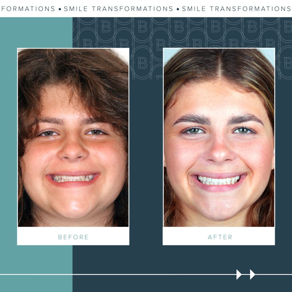 Orthodontics Before and Afters