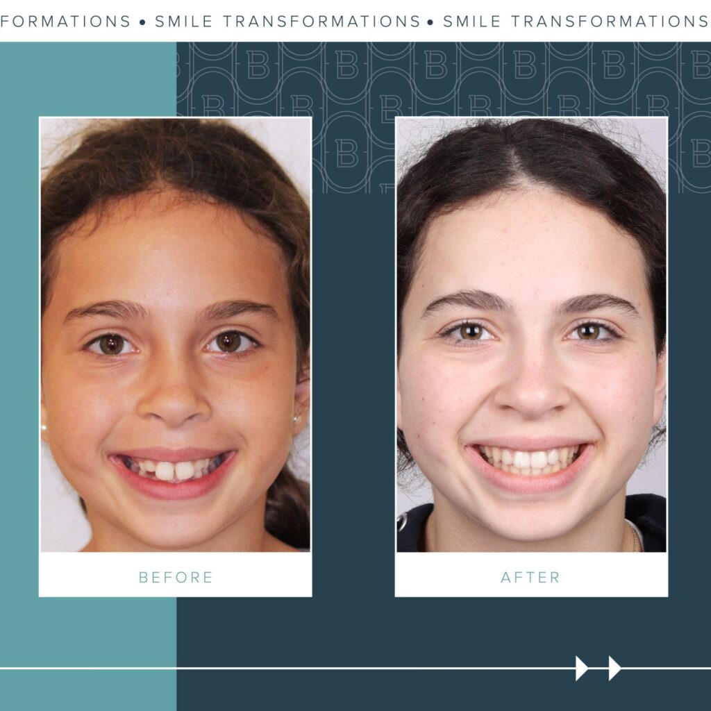 Orthodontics Before and Afters