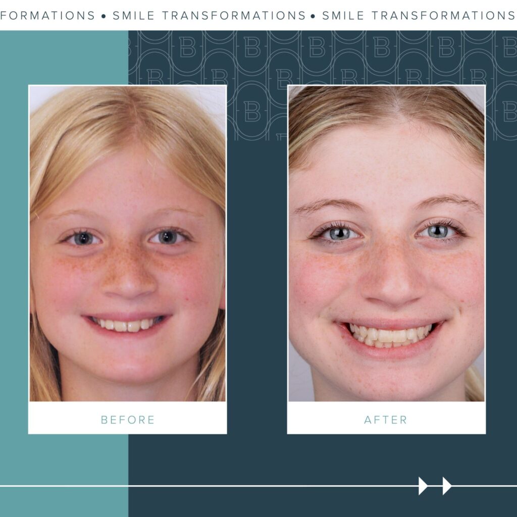 Orthodontics Before and Afters