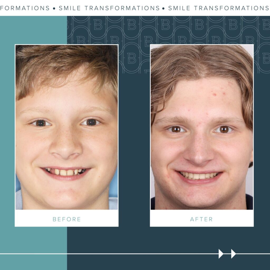 Orthodontics Before and Afters