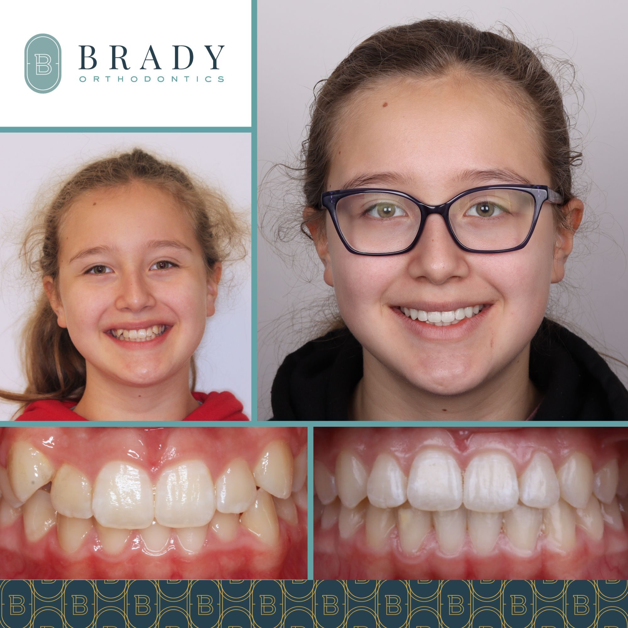 Orthodontics Before and Afters