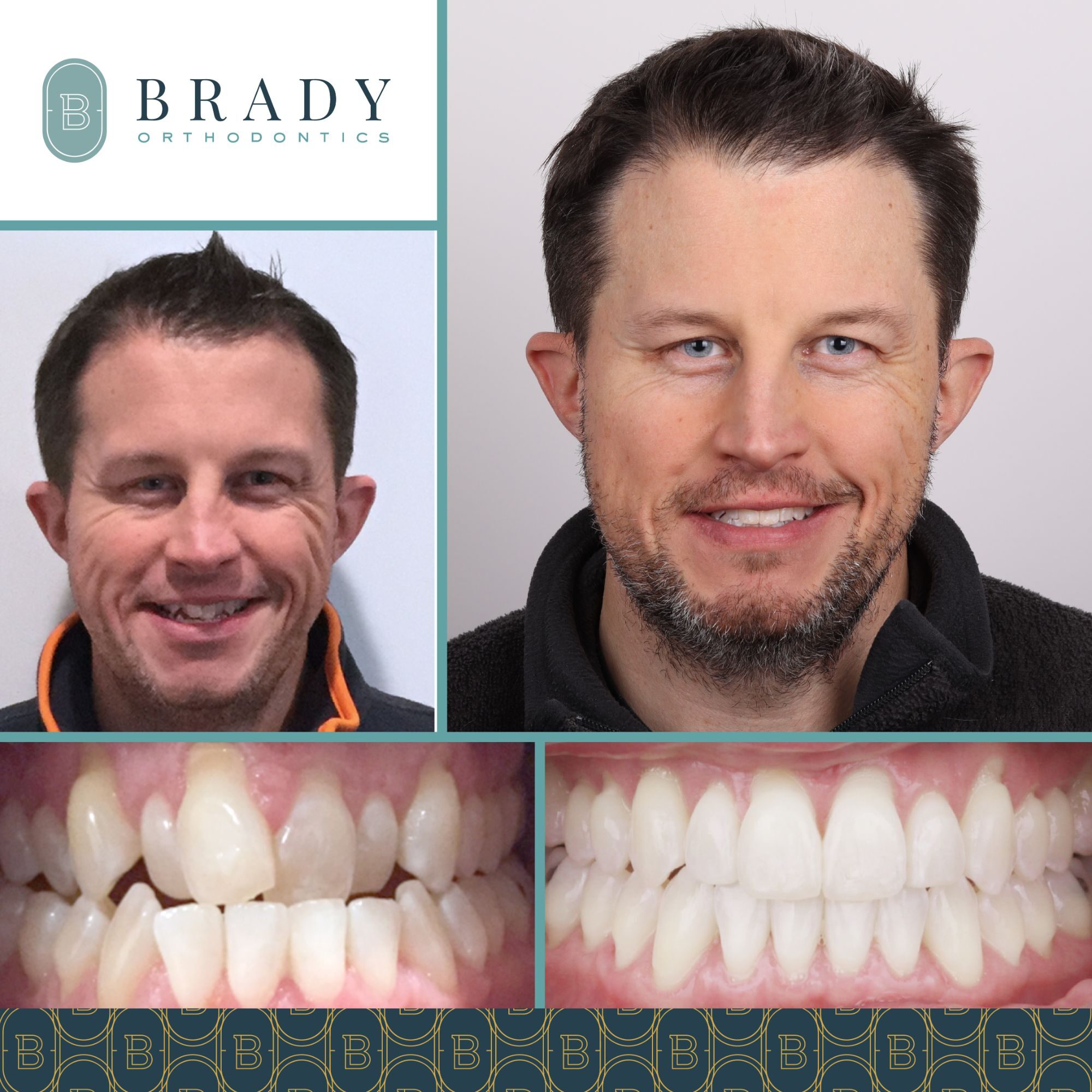 Orthodontics Before and Afters