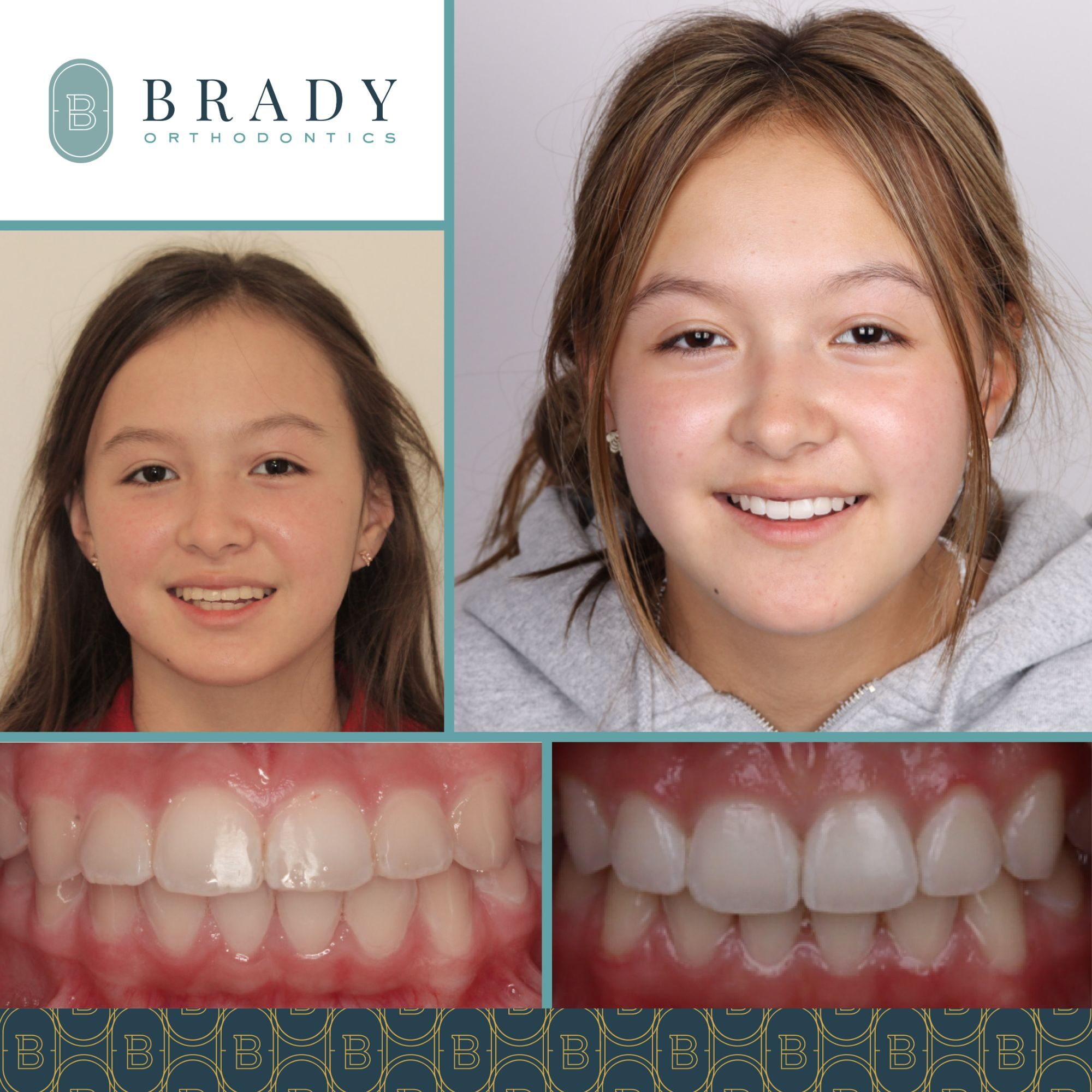 Orthodontics Before and Afters
