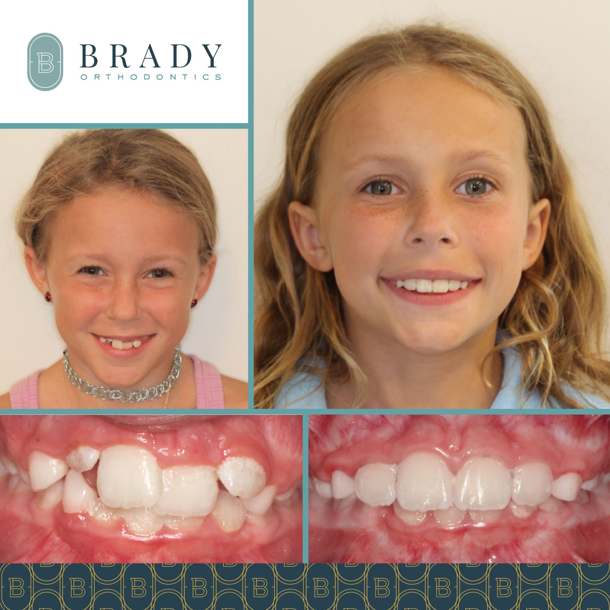 Orthodontics Before and Afters